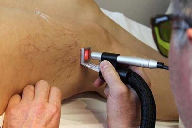 Laser treatment of varicose veins of the lower extremities